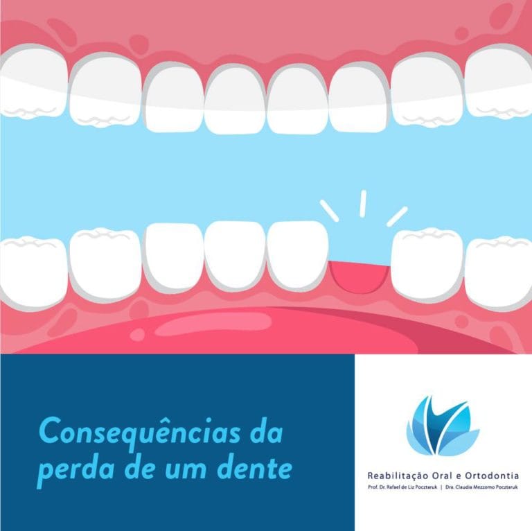 Dr. Rafael Pocztaruk perda de um dente Dr. Rafael Pocztaruk perda de um dente