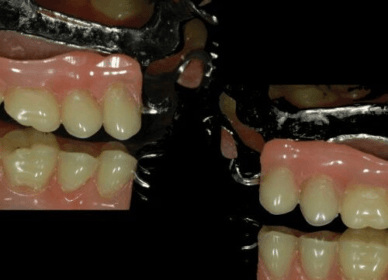 protese-500x432 protese-500x432