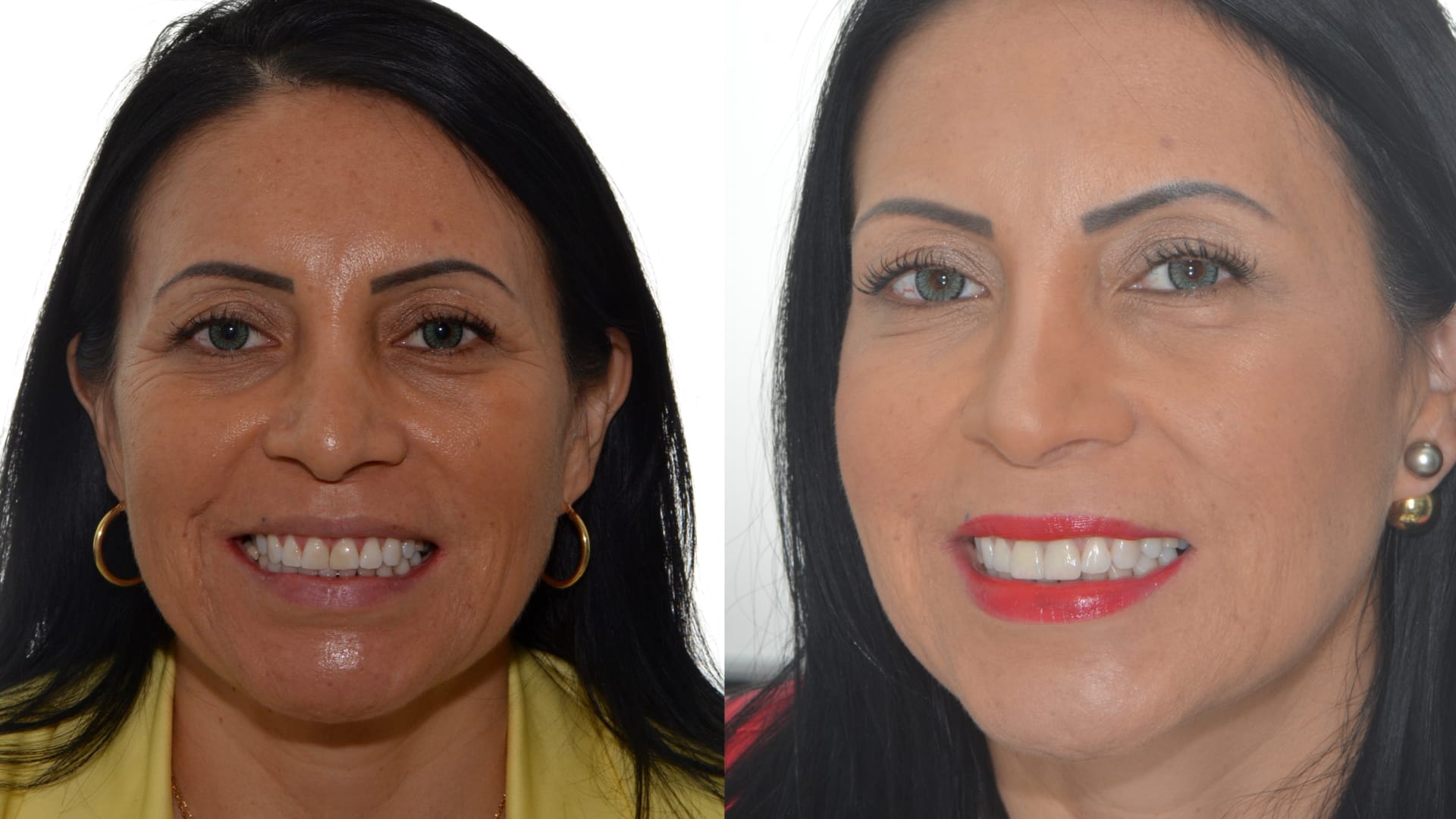 Antex x depois .001 Antex x depois .001