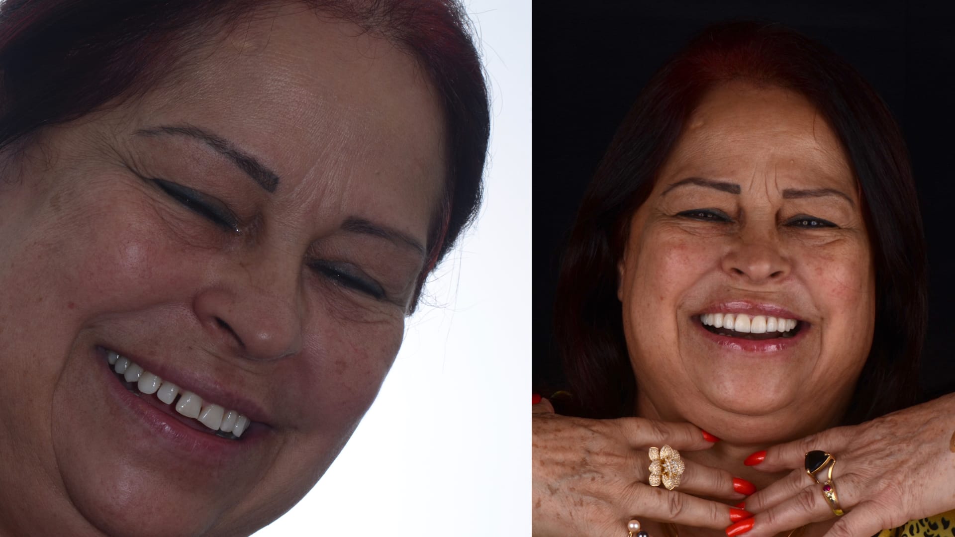 Antex x depois .003 Antex x depois .003