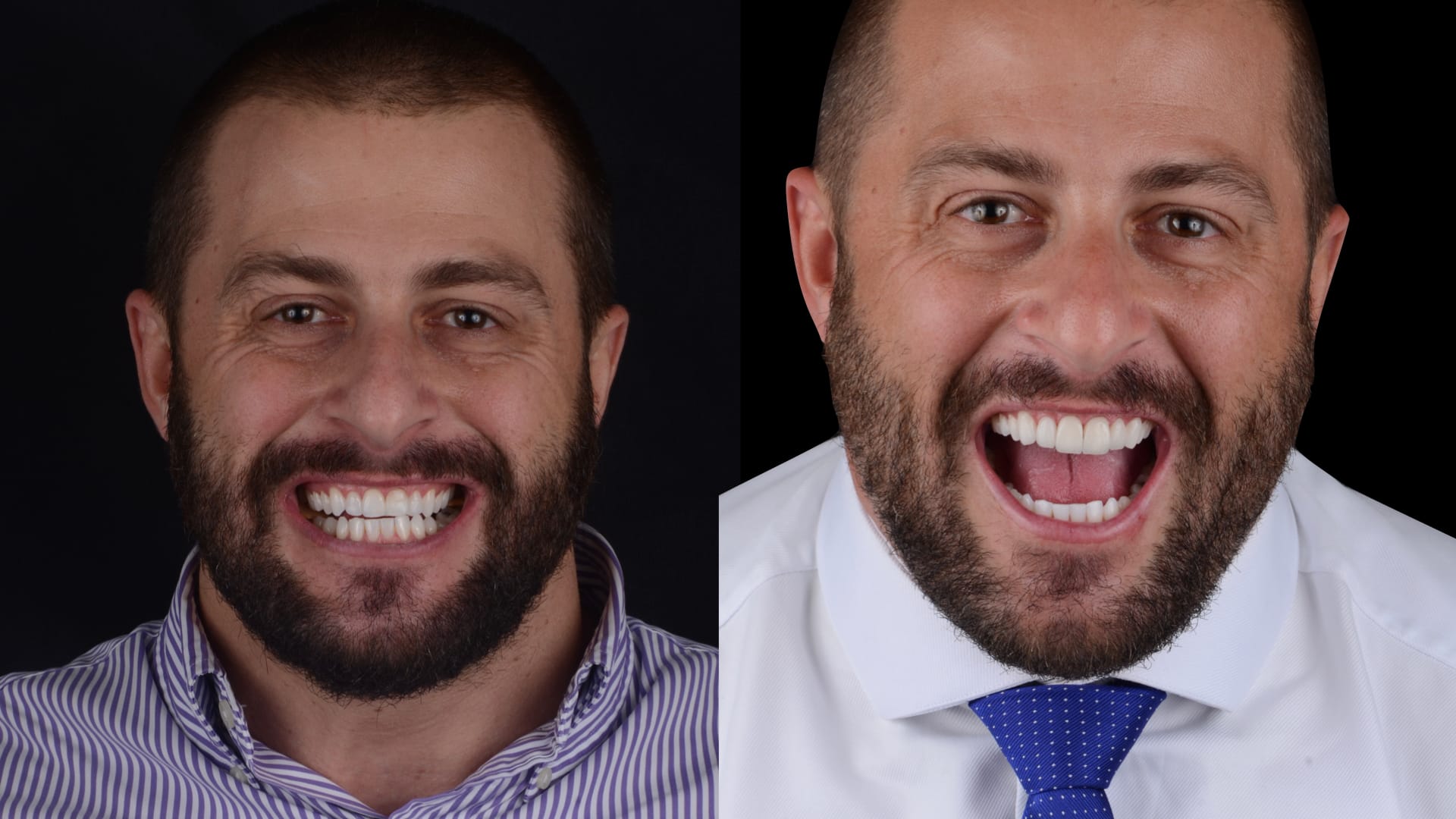 Antex x depois .004 Antex x depois .004