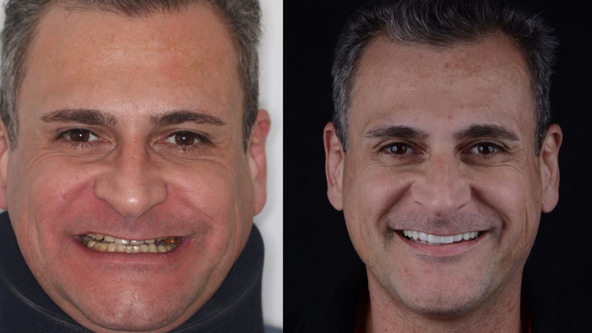 Antex x depois .009 Antex x depois .009