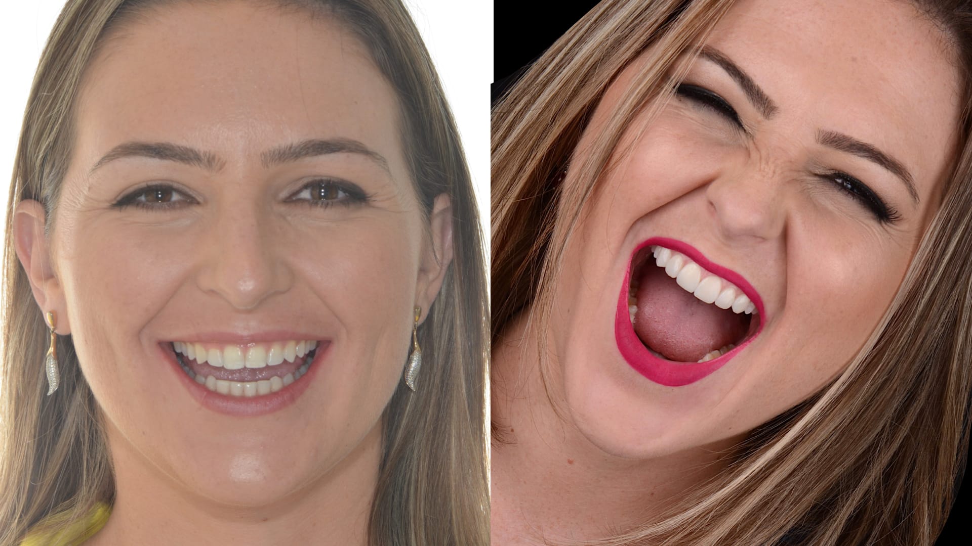 Antex x depois .011 Antex x depois .011