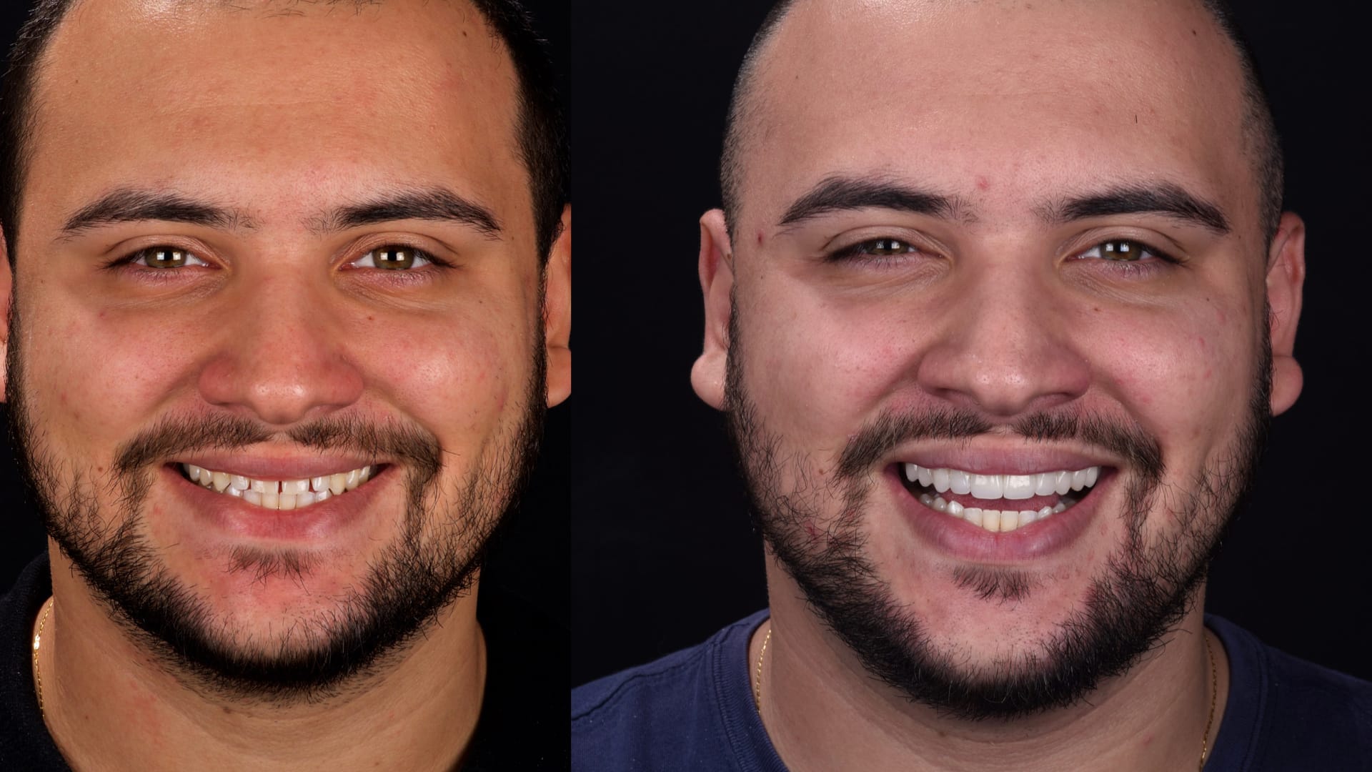 Antex x depois .015 Antex x depois .015