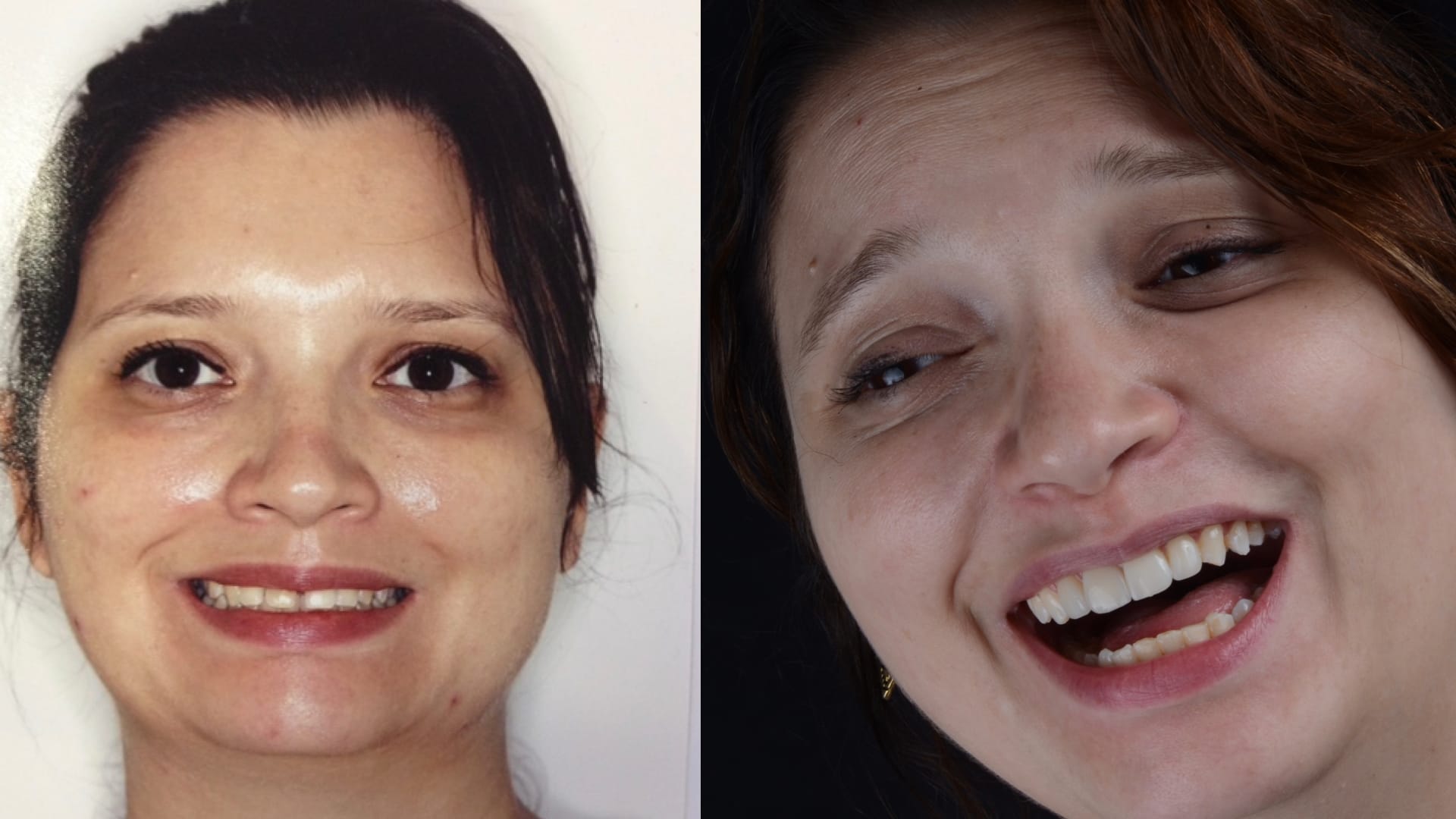 Antex x depois .017 Antex x depois .017