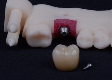 Protese-sobre-implante-dentario-precisao-estetica Protese-sobre-implante-dentario-precisao-estetica