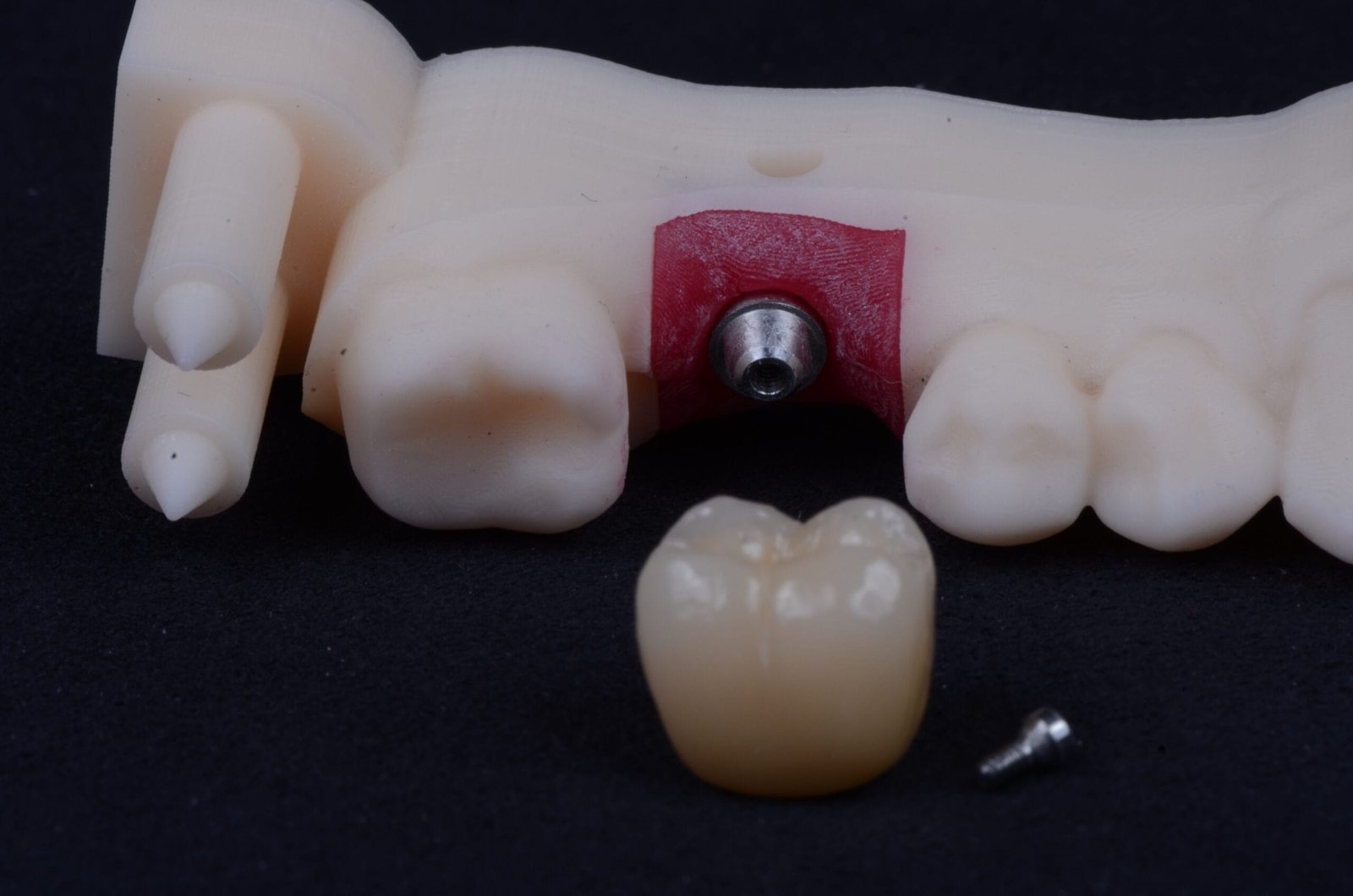 Protese-sobre-implante-dentario-precisao-estetica Protese-sobre-implante-dentario-precisao-estetica