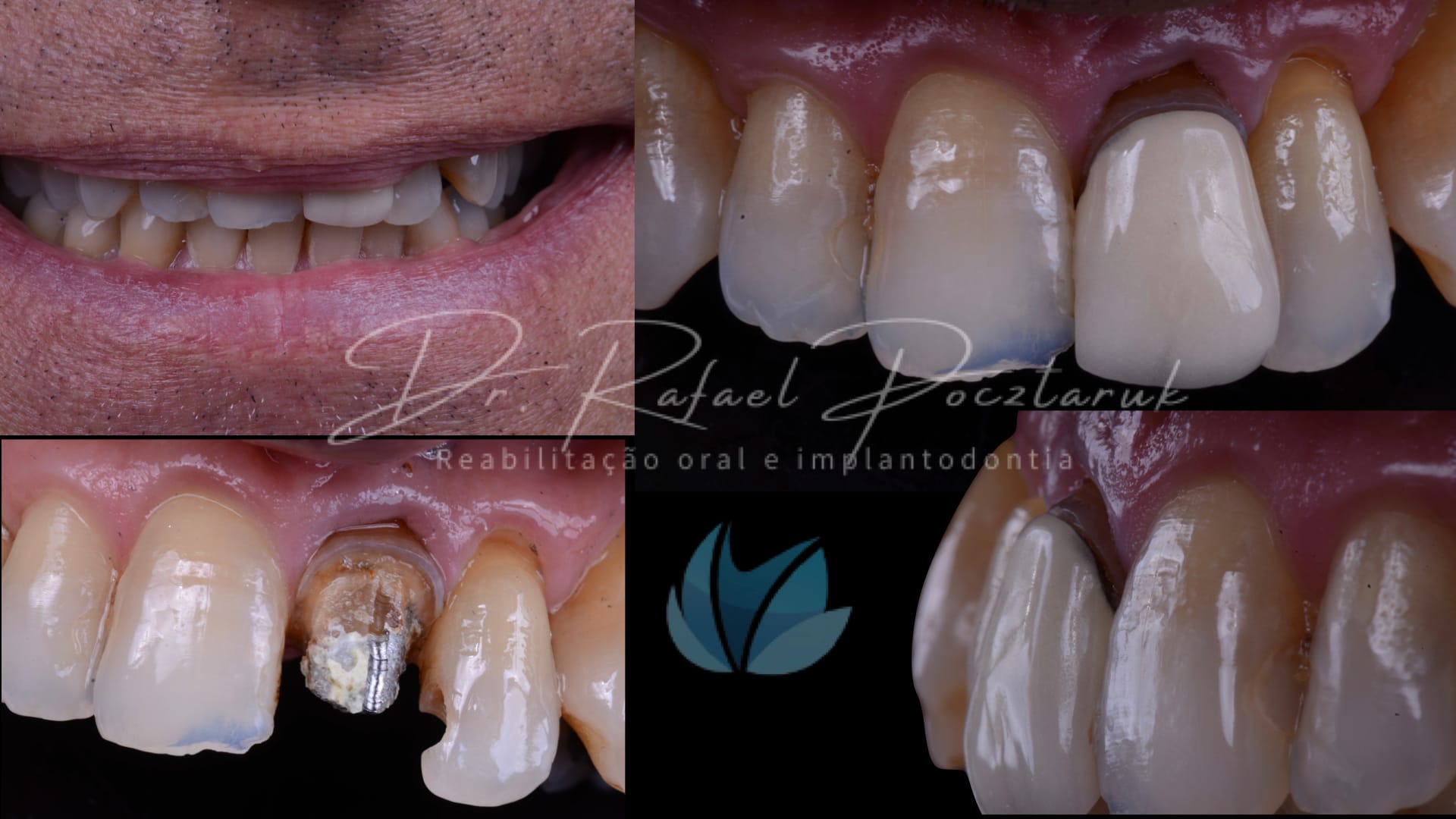 Implante unitario Craga imediata.001