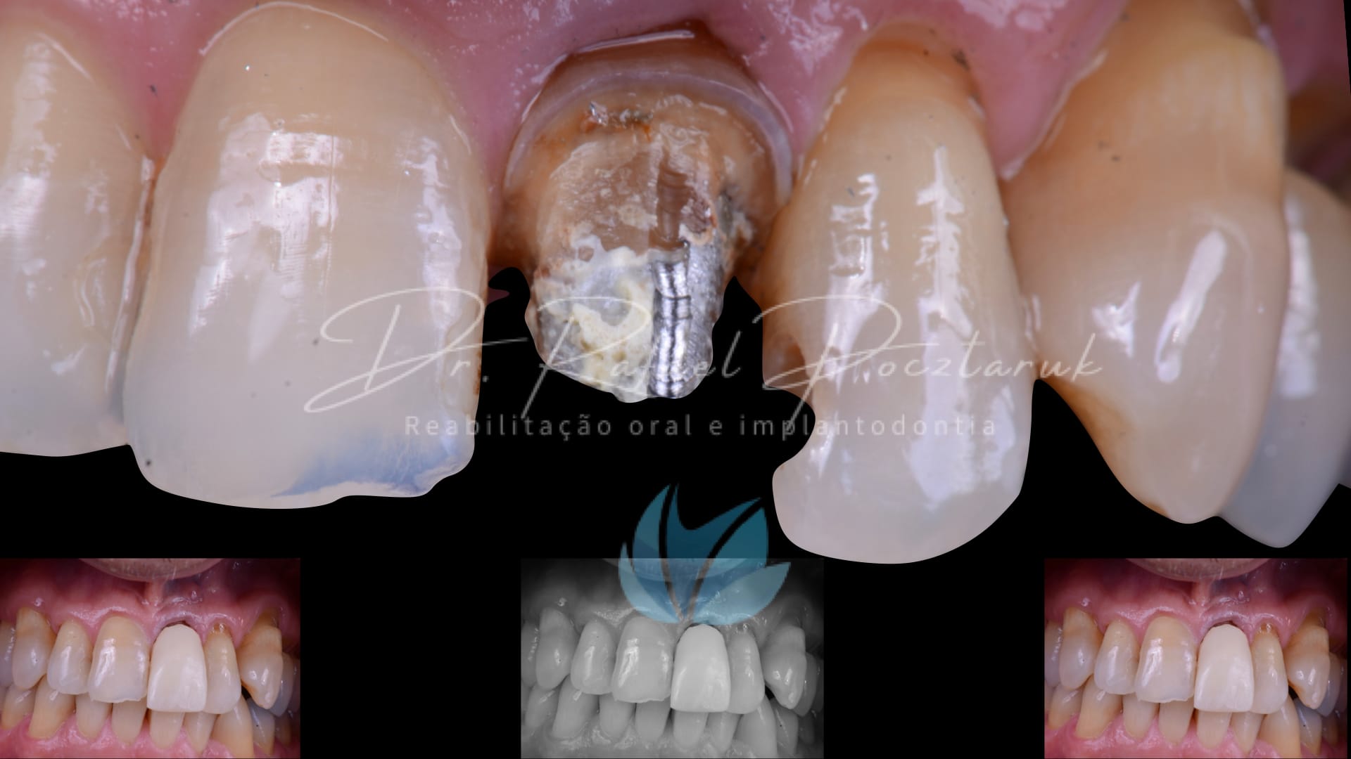 Implante unitario Craga imediata.002