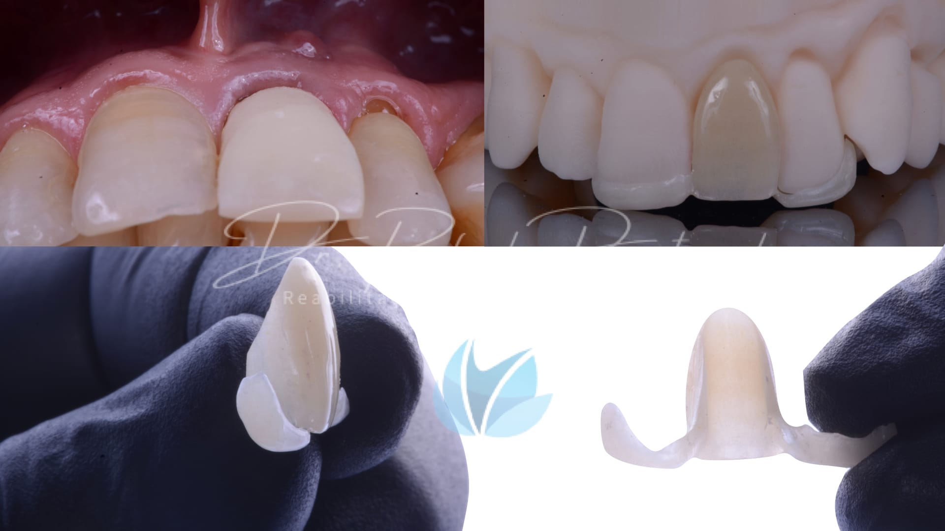 Implante unitario Craga imediata.004