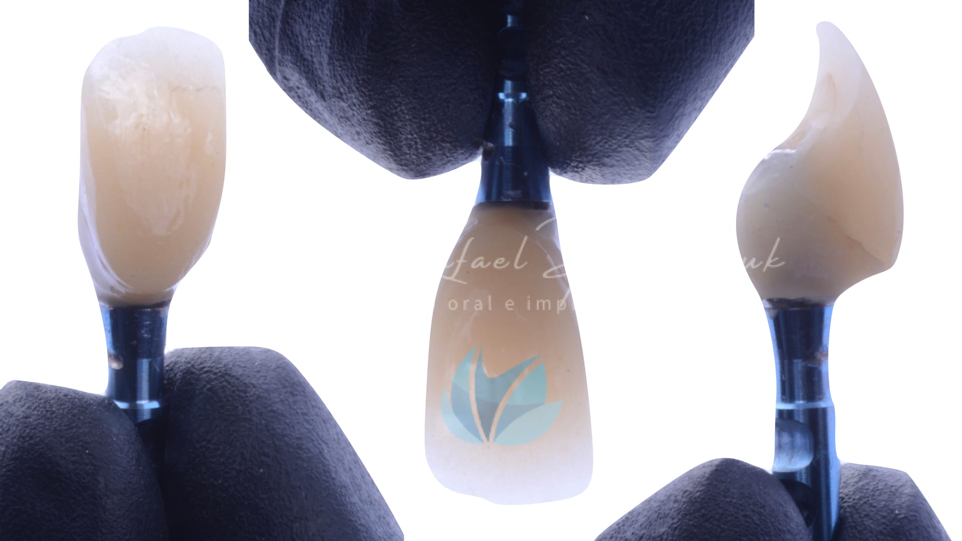 Implante unitario Craga imediata.005