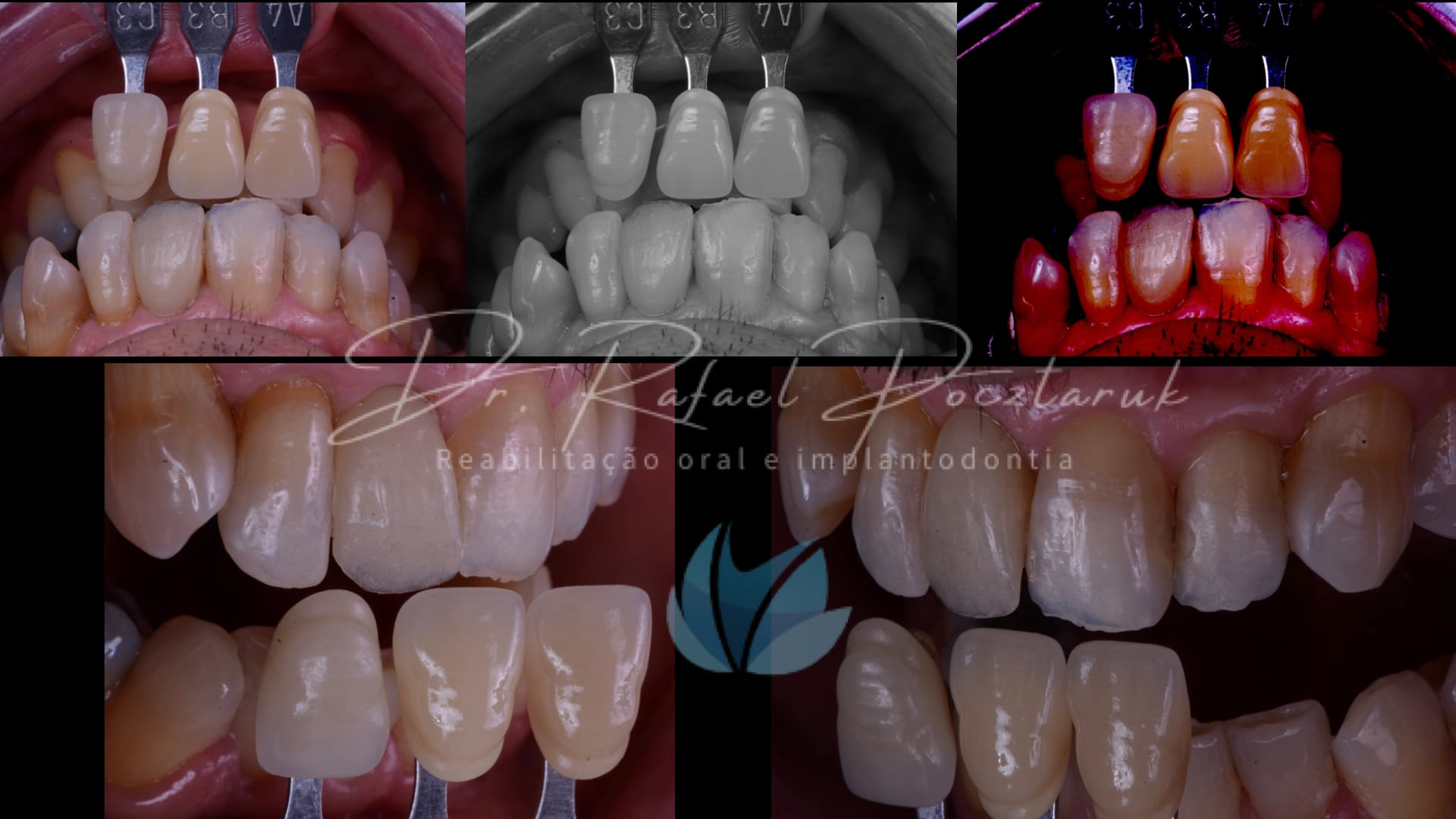 Implante unitario Craga imediata.006