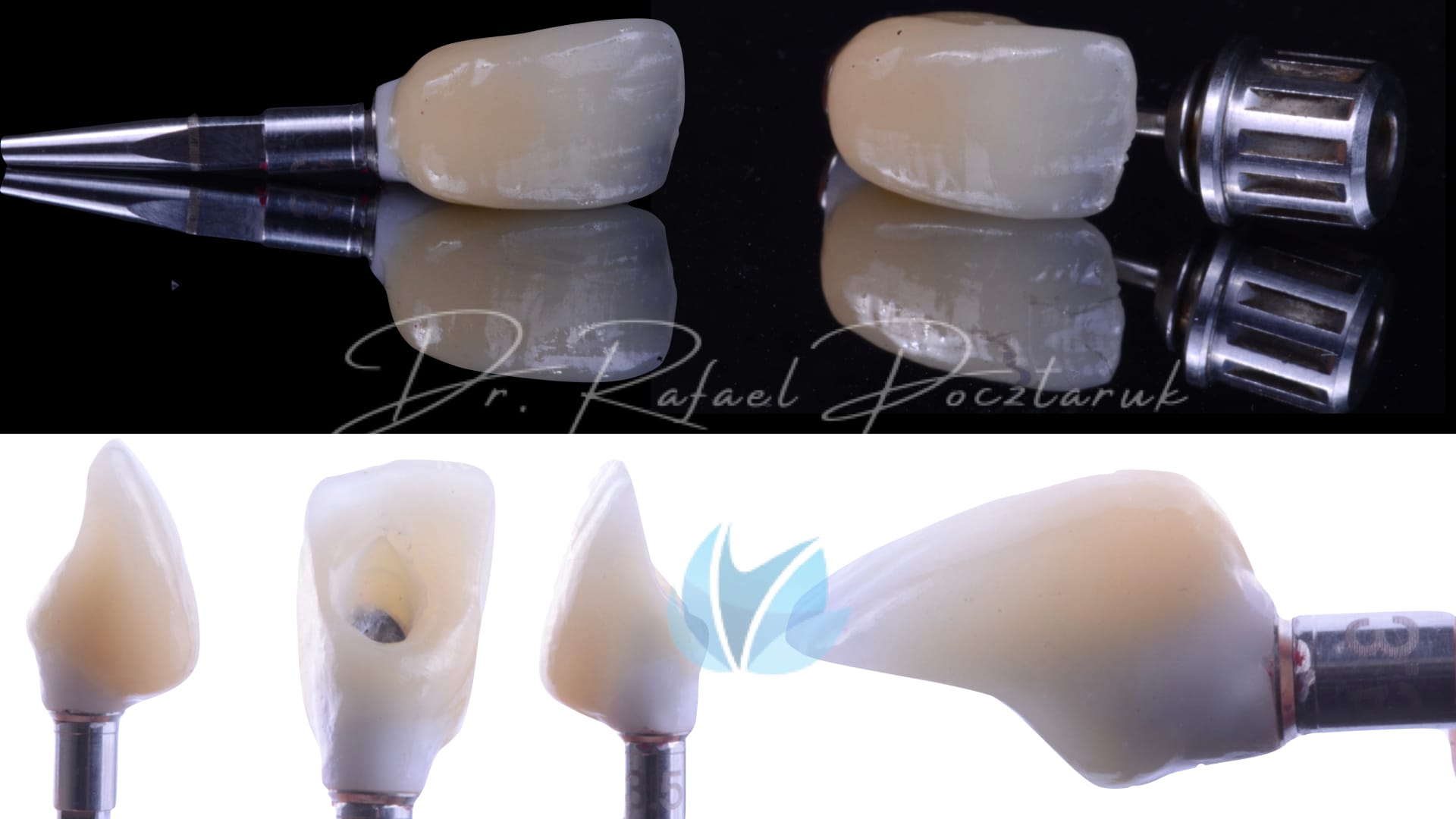 Implante unitario Craga imediata.007