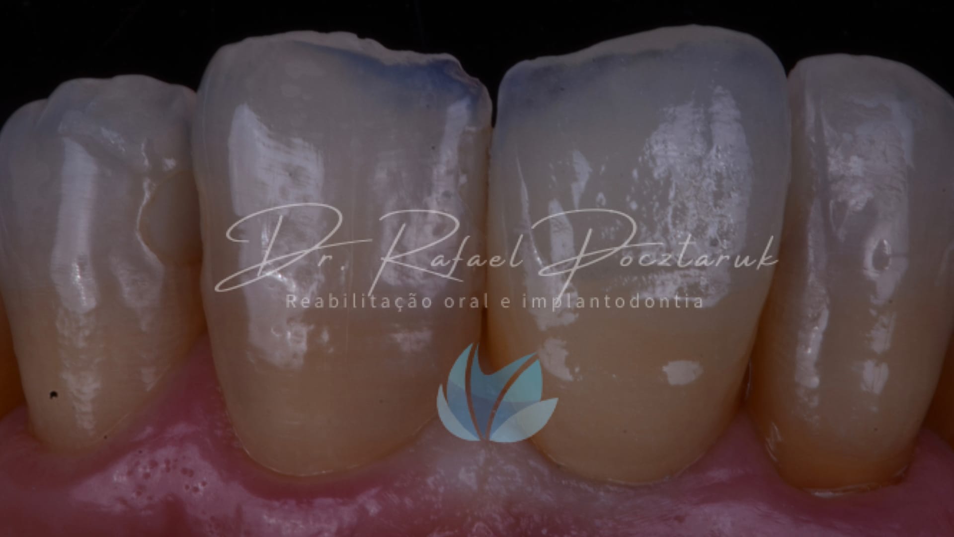 Implante unitario Craga imediata.009