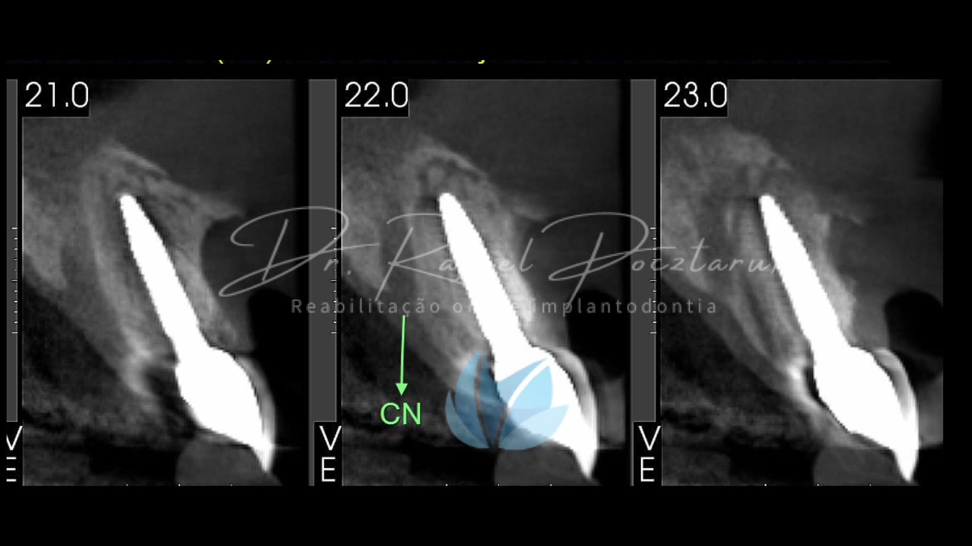 Implante unitario Craga imediata.010
