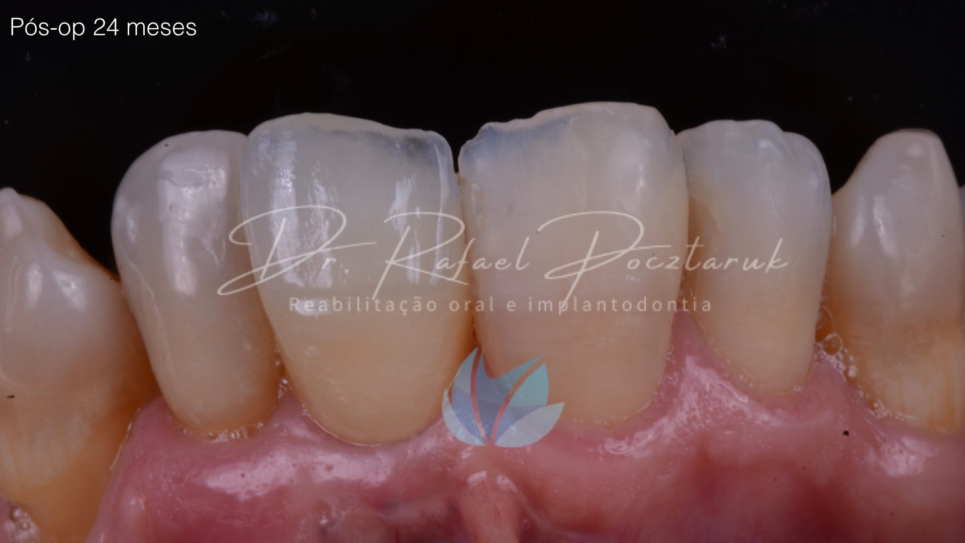 Implante unitario Craga imediata.011