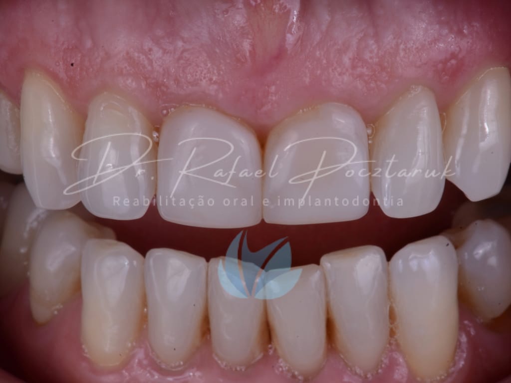 Moldagem em PPF completa com Digital .001