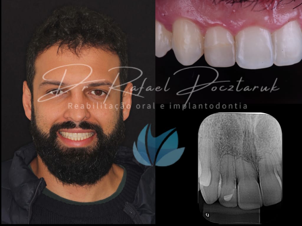 Moldagem em PPF completa com Digital .001