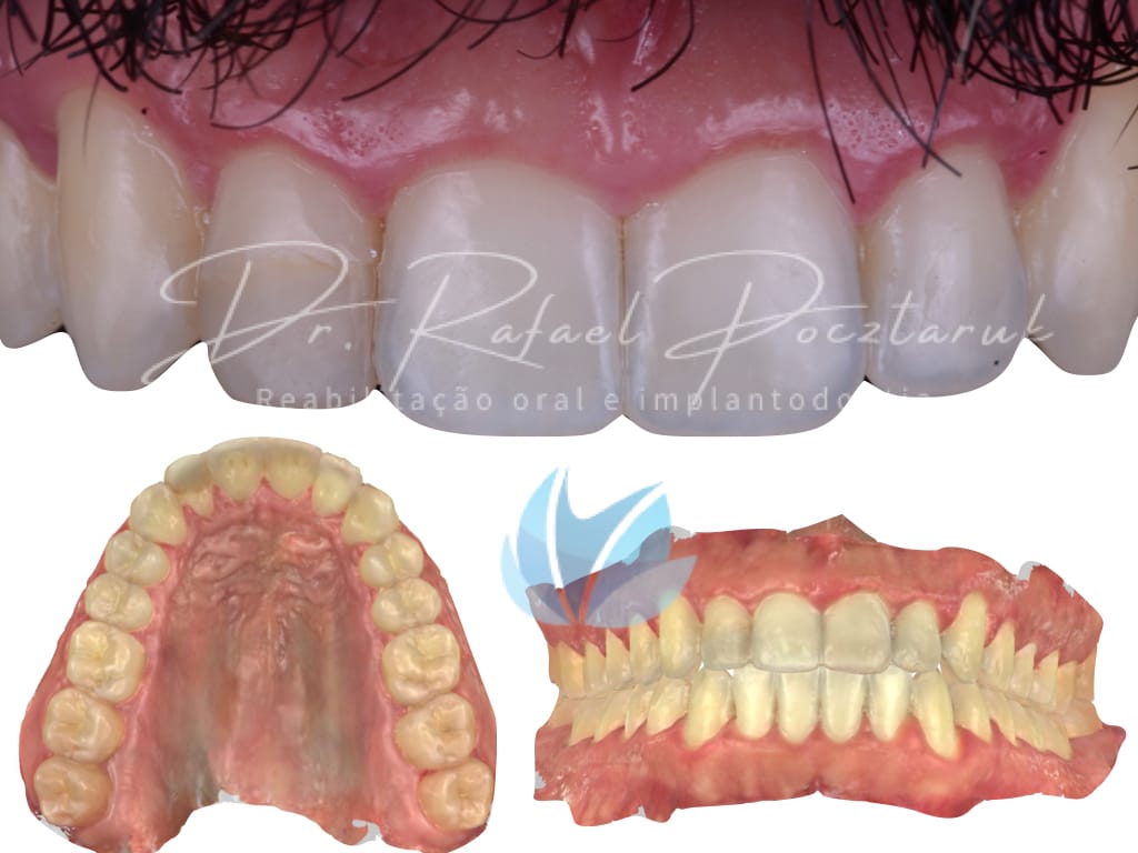 Moldagem em PPF completa com Digital .002