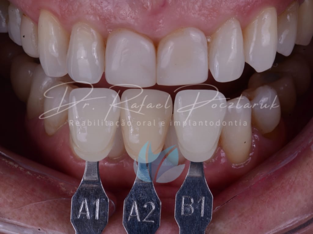 Moldagem em PPF completa com Digital .003