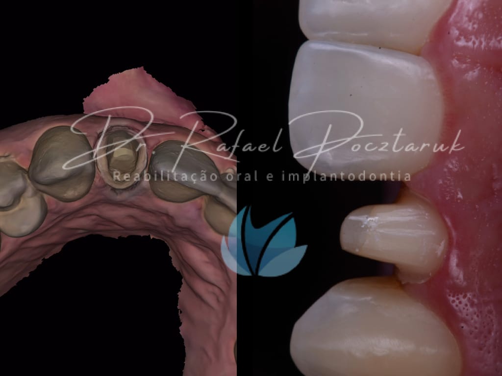 Moldagem em PPF completa com Digital .003