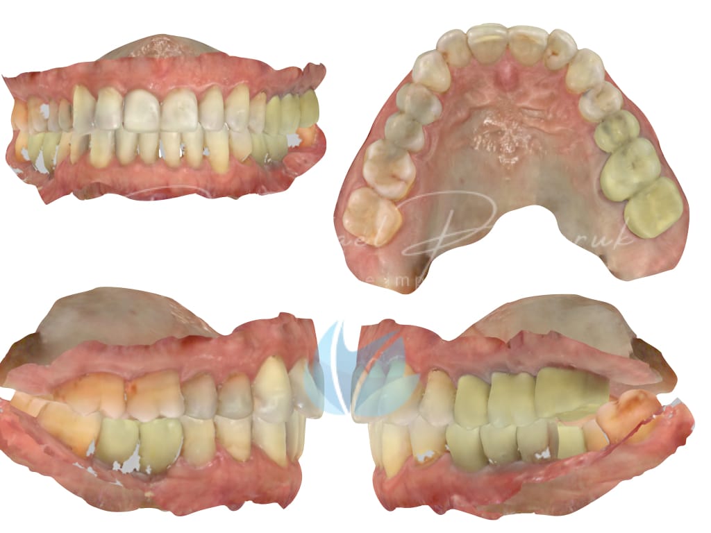Moldagem em PPF completa com Digital .004