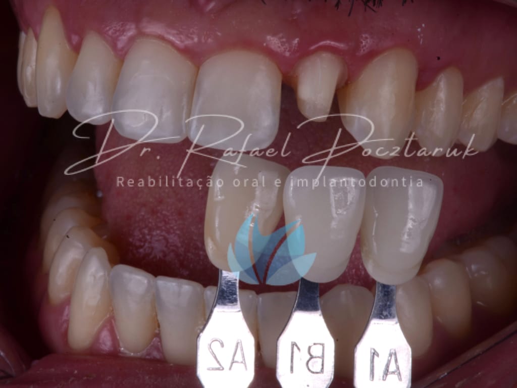 Moldagem em PPF completa com Digital .004