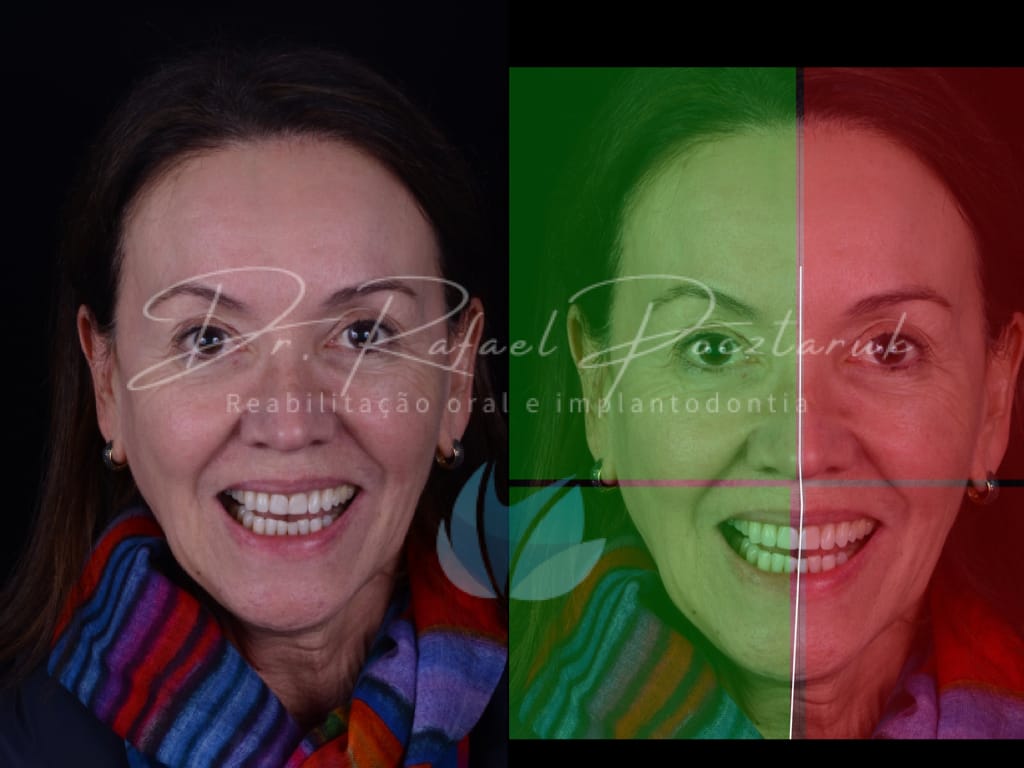 Moldagem em PPF completa com Digital .005