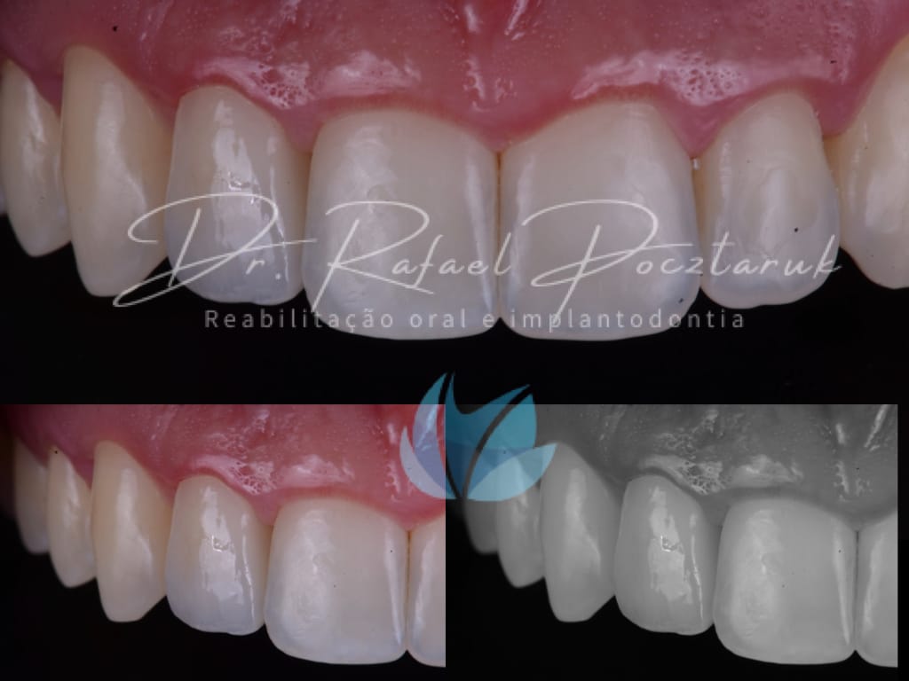 Moldagem em PPF completa com Digital .005