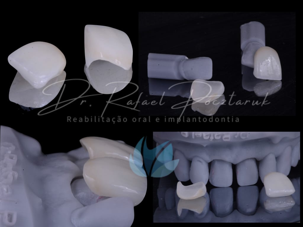 Moldagem em PPF completa com Digital .010