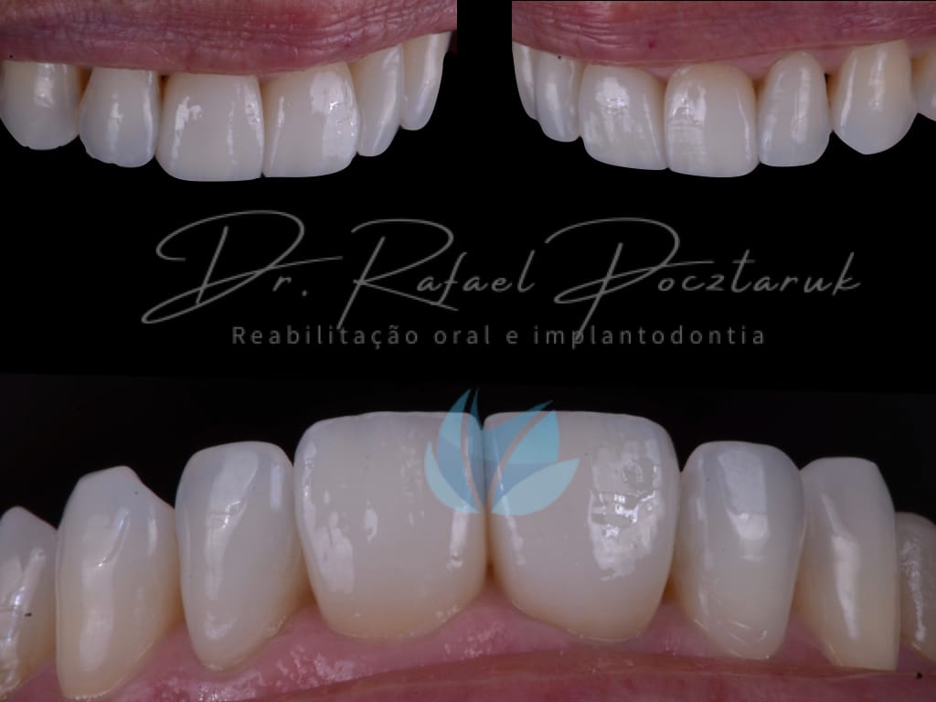 Moldagem em PPF completa com Digital .013