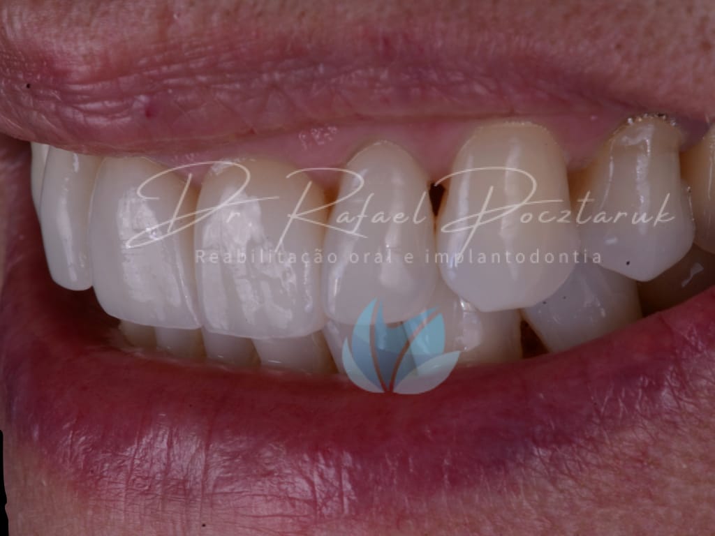 Moldagem em PPF completa com Digital .014