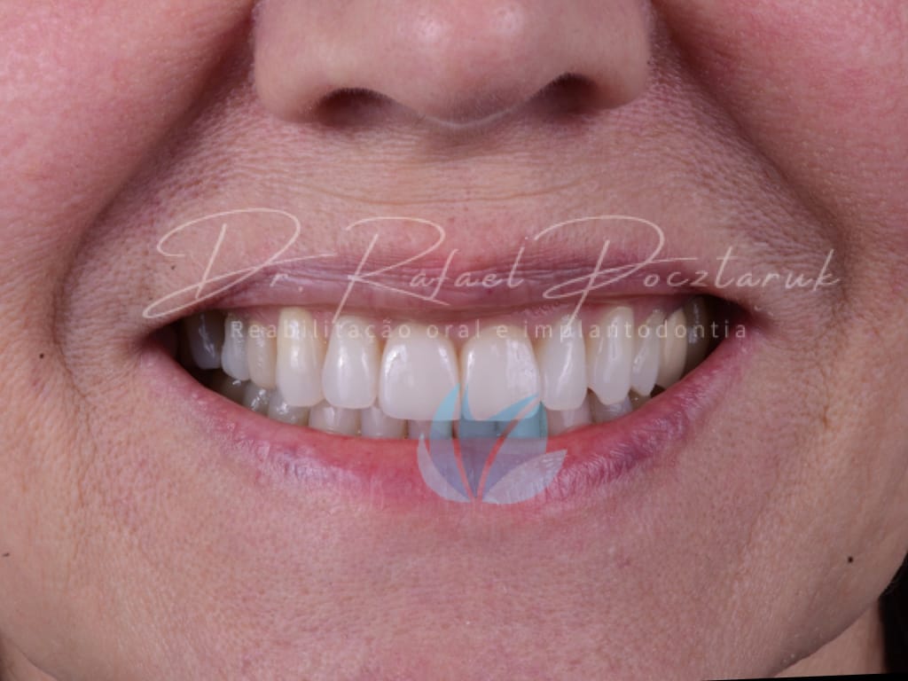 Moldagem em PPF completa com Digital .015