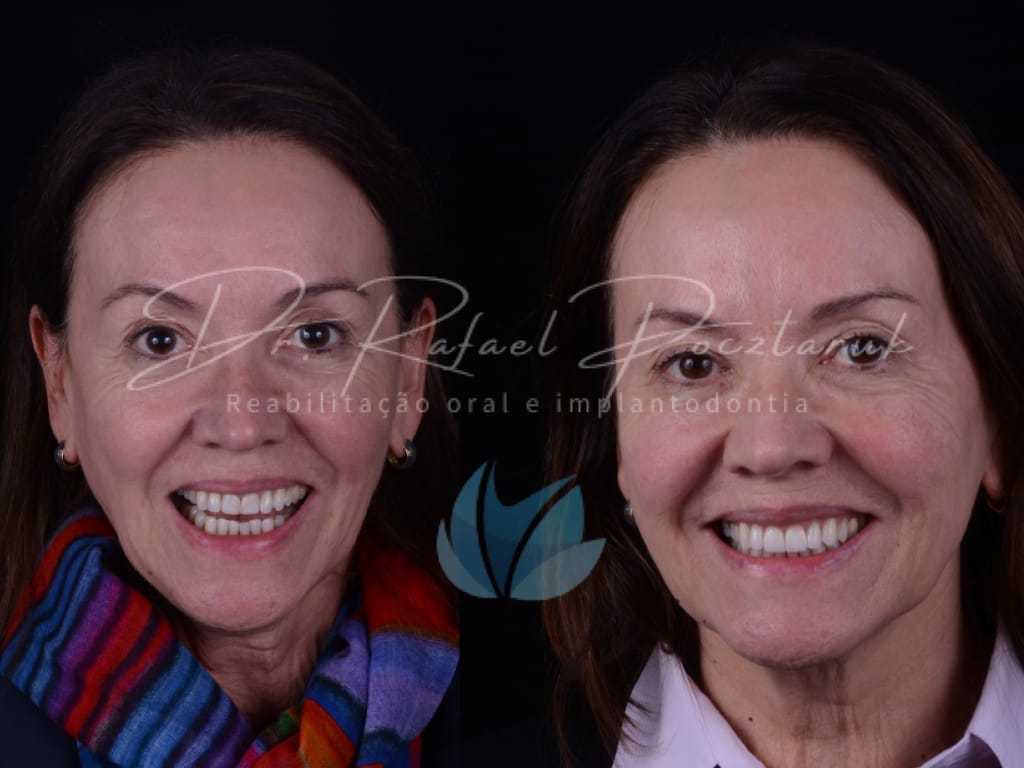 Moldagem em PPF completa com Digital .016