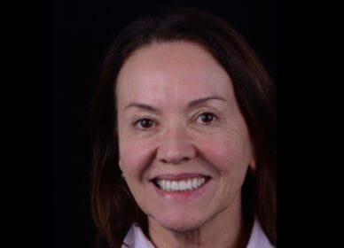 Moldagem em PPF completa com Digital .017