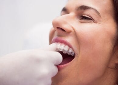 Alinhador transparente Invisalign em uso Alinhador transparente Invisalign em uso