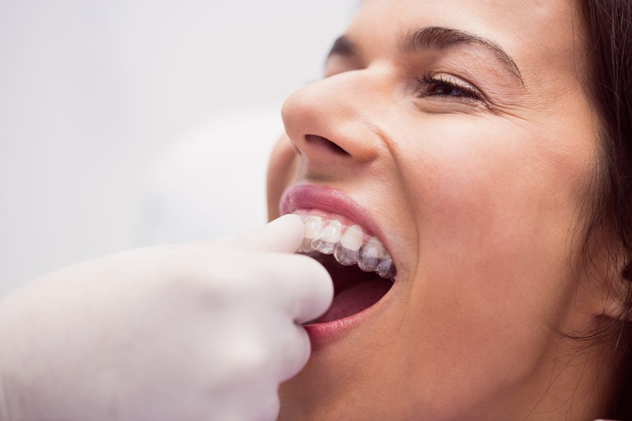 Alinhador transparente Invisalign em uso