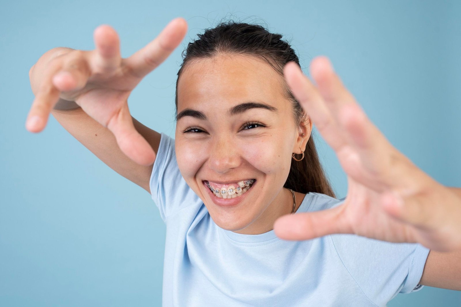 Sorriso perfeito após tratamento com aparelho ortodôntico Sorriso perfeito após tratamento com aparelho ortodôntico