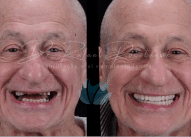 Consulta e Tratamento de Implantes Dentários