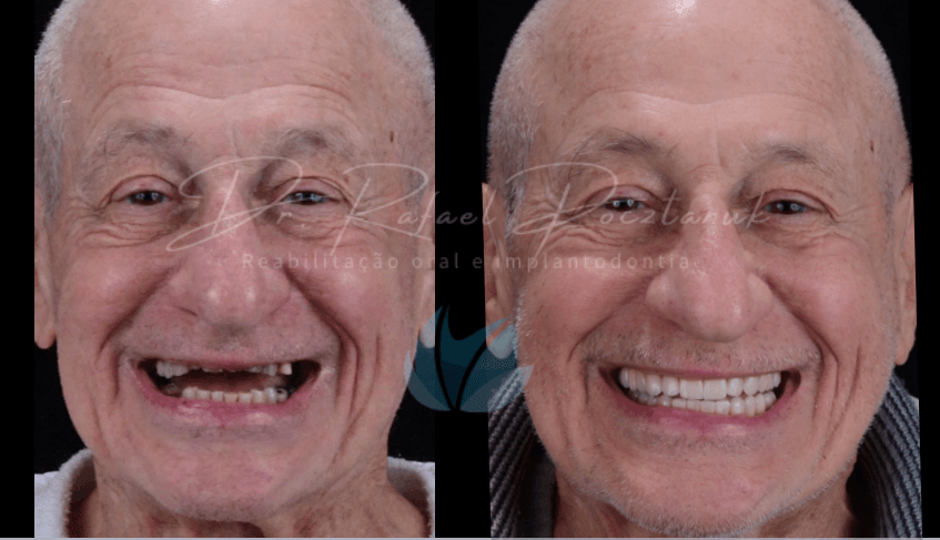 Consulta e Tratamento de Implantes Dentários